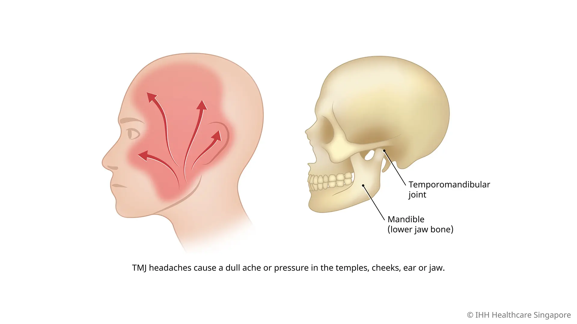 What is a temporomandibular joint (TMJ) headache