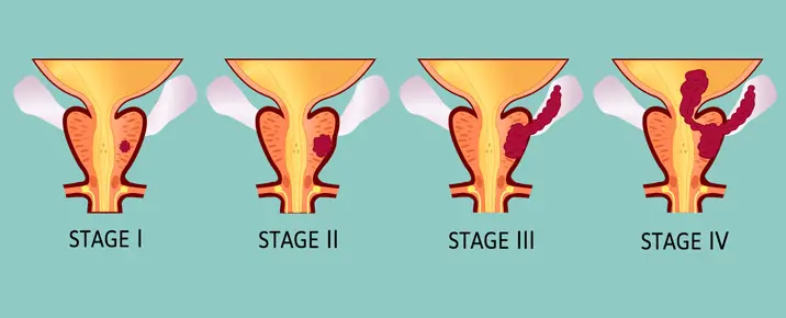 Prostate cancer at different stages