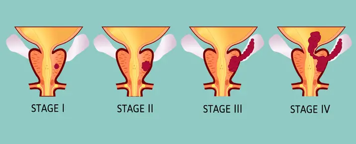 Kanker prostat pada berbagai stadium