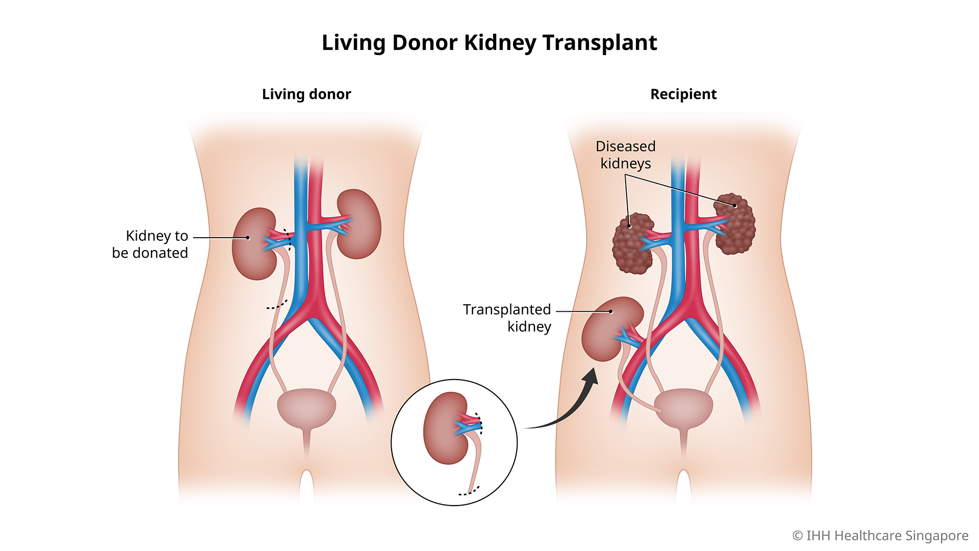 Living-Donor-Kidney-Transplant-6-01