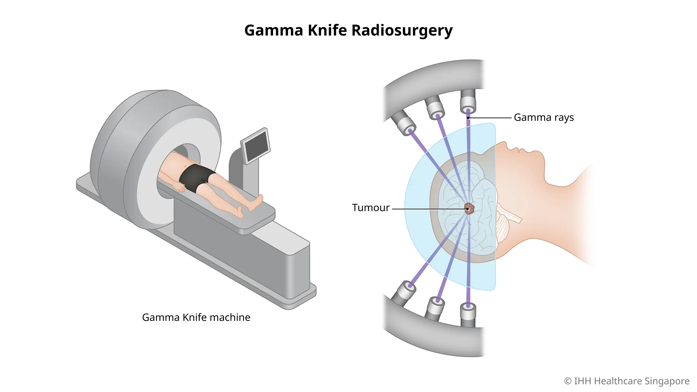 Bedah Radiasi Pisau Gamma