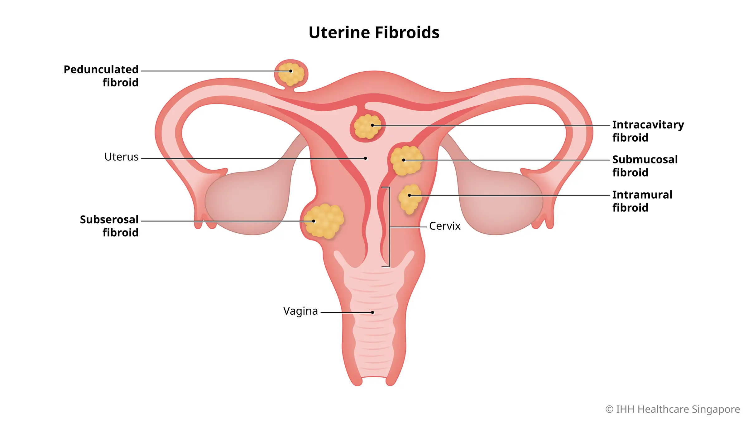Beragam jenis fibroid uterine dengan gejalanya masing-masing.