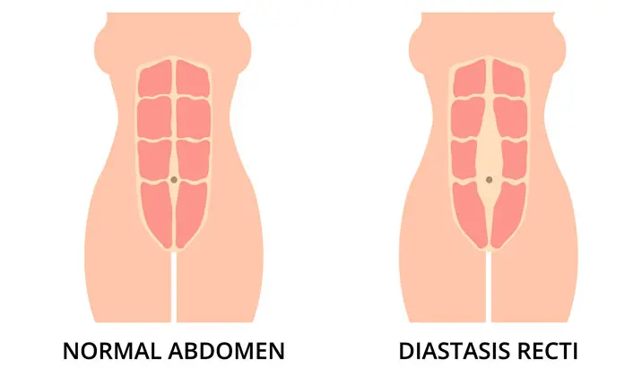 Diastasis rekti