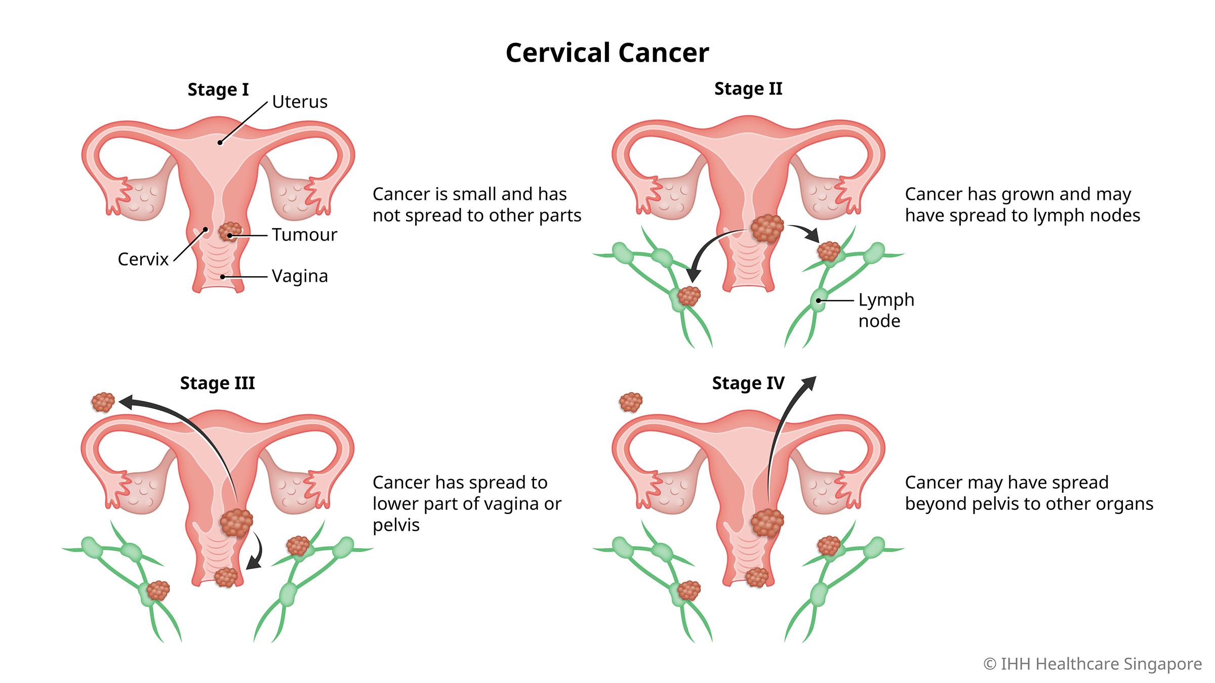 Cervical Cancer - Symptoms & Causes