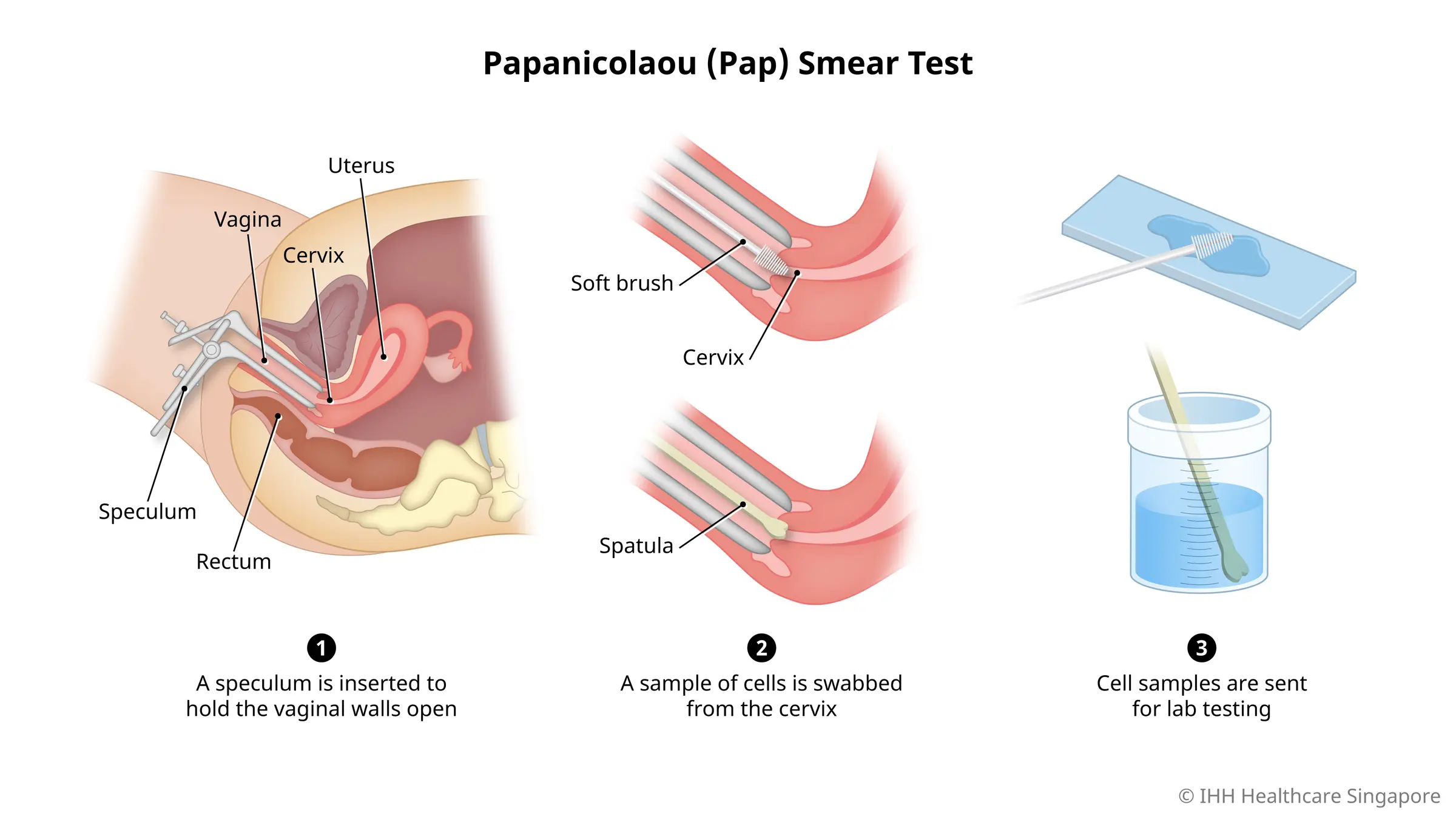 What can you expect in a Pap smear?