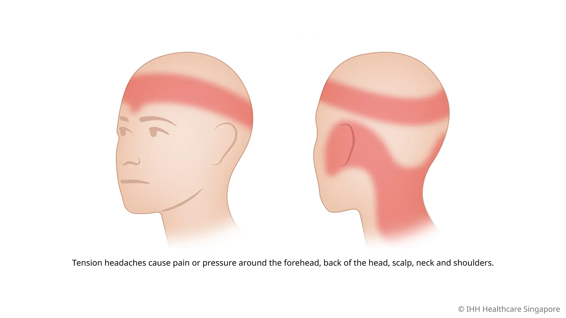 What is a tension headache