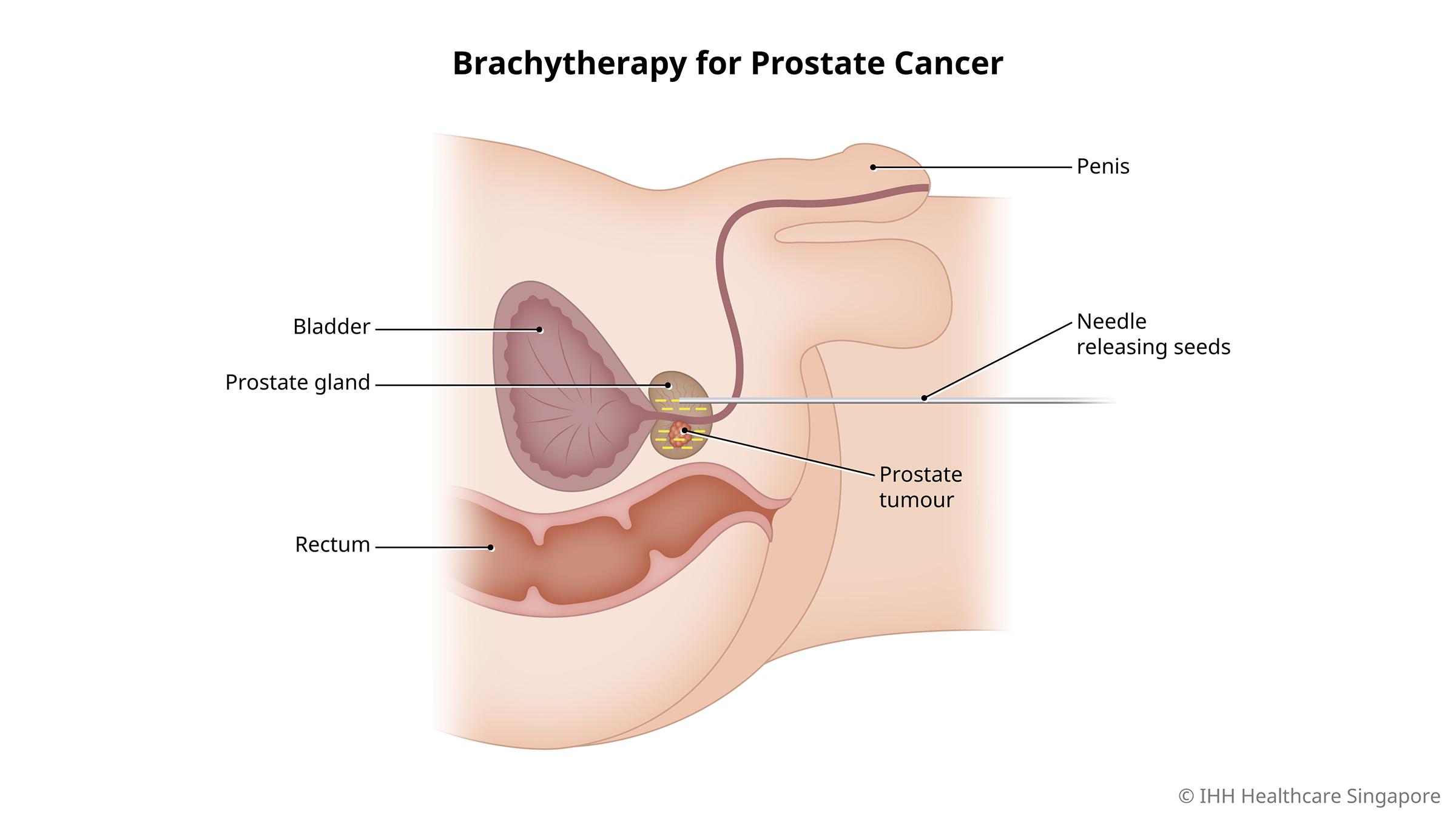Brakiterapi untuk Kanker Prostat
