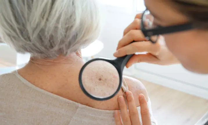 Specialist diagnosing skin cancer symptoms