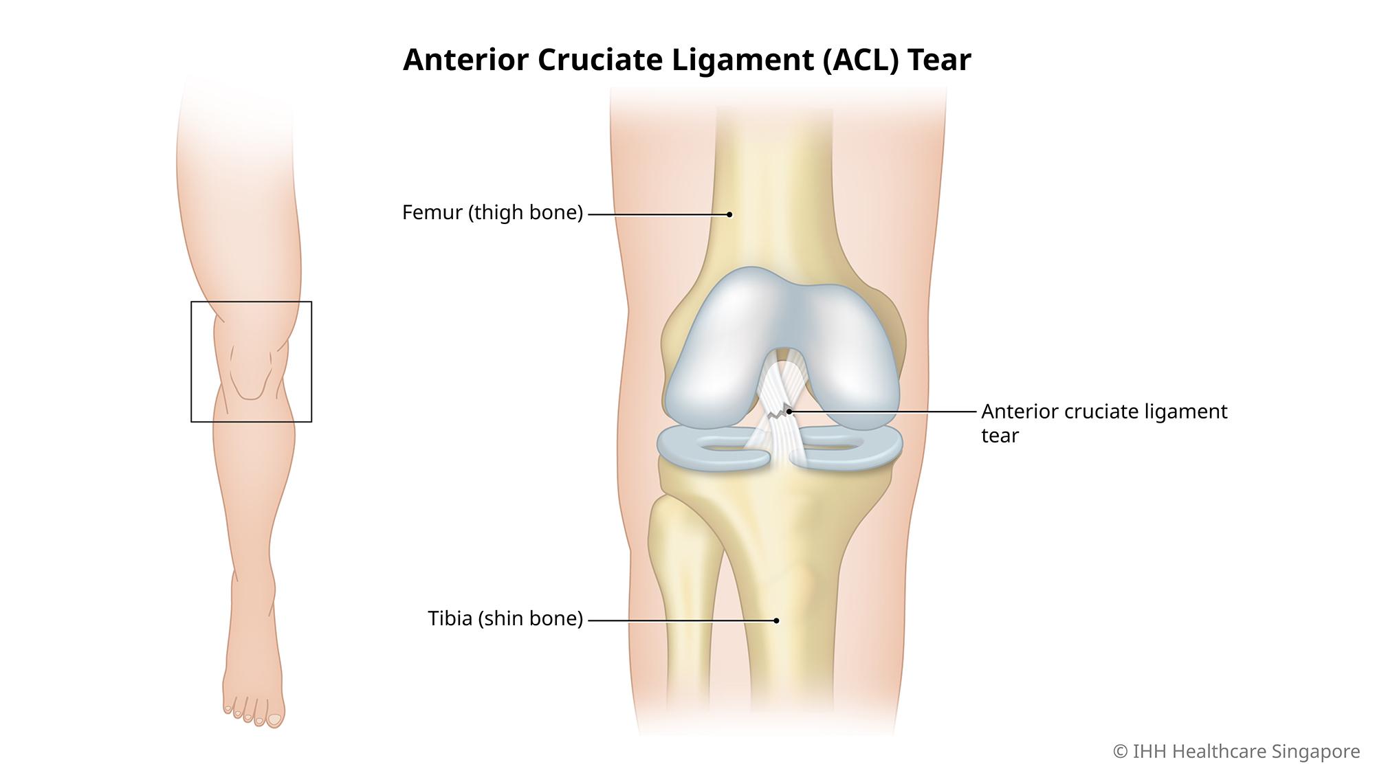 膝关节前交叉韧带 (ACL) 撕裂指膝关节韧带部分或完全撕裂。