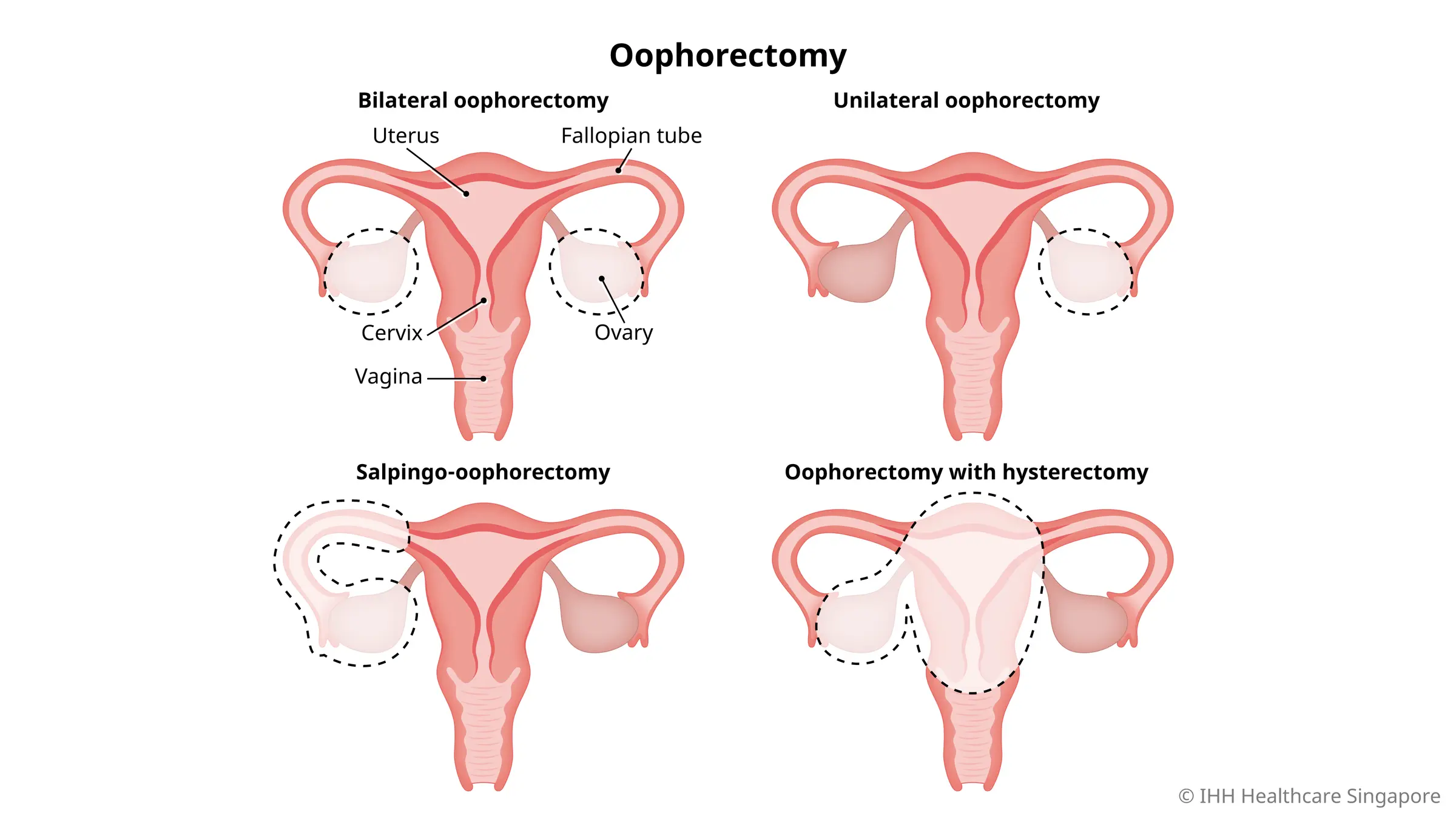 Types of oophorectomy