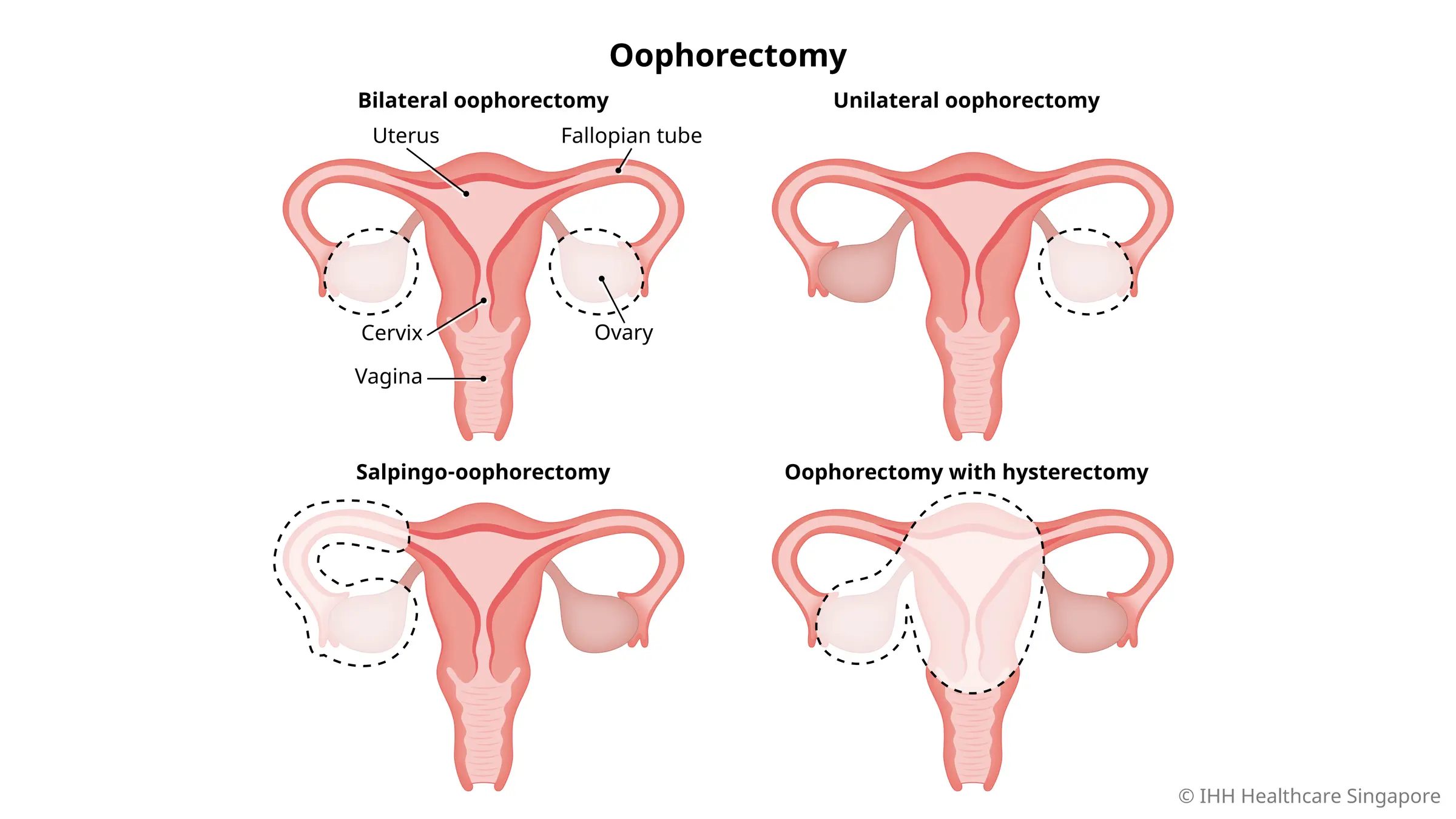 Laparoscopic Oophorectomy for Ovarian Torsion • Video •