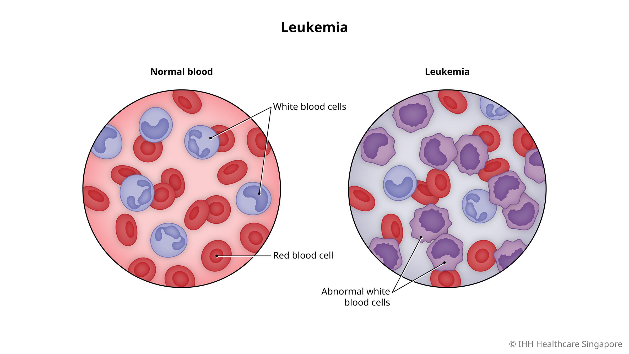 how quickly does leukemia develop