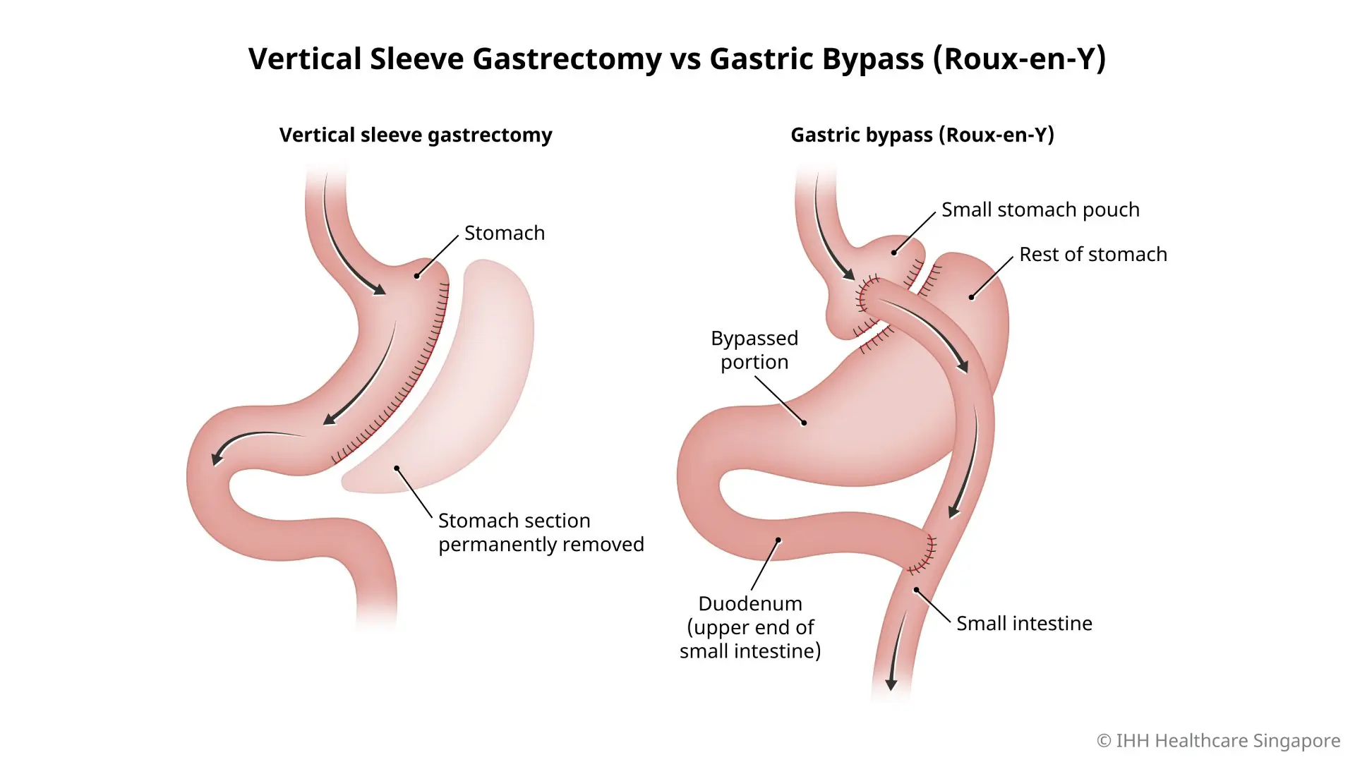 Illustration of the differences between vertical sleeve gastrectomy surgery and gastric bypass (Roux-en-Y) surgery.