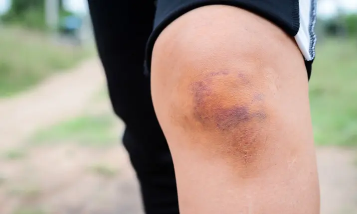 Bruise on womans knee