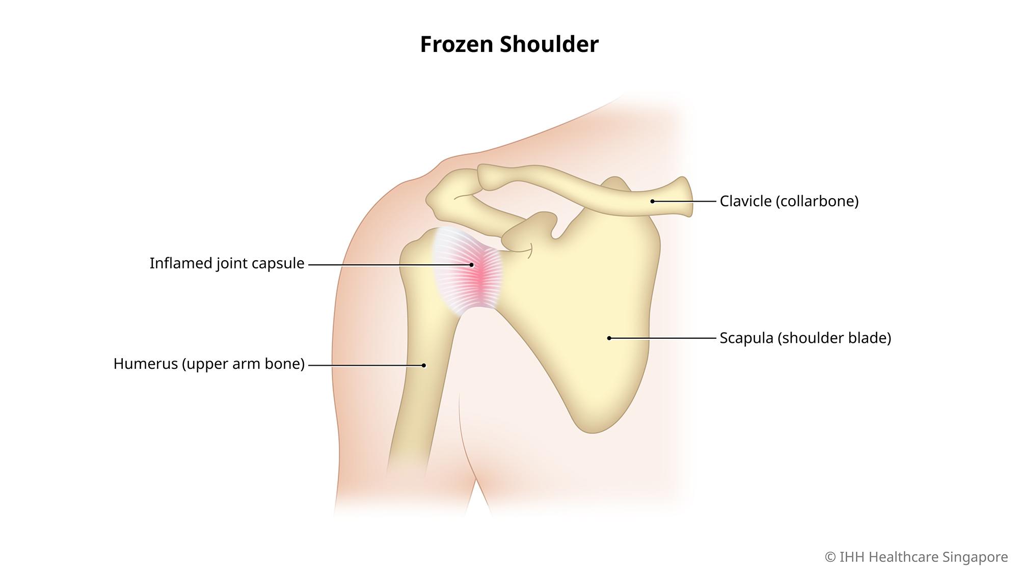 Frozen shoulder, also known as adhesive capsulitis