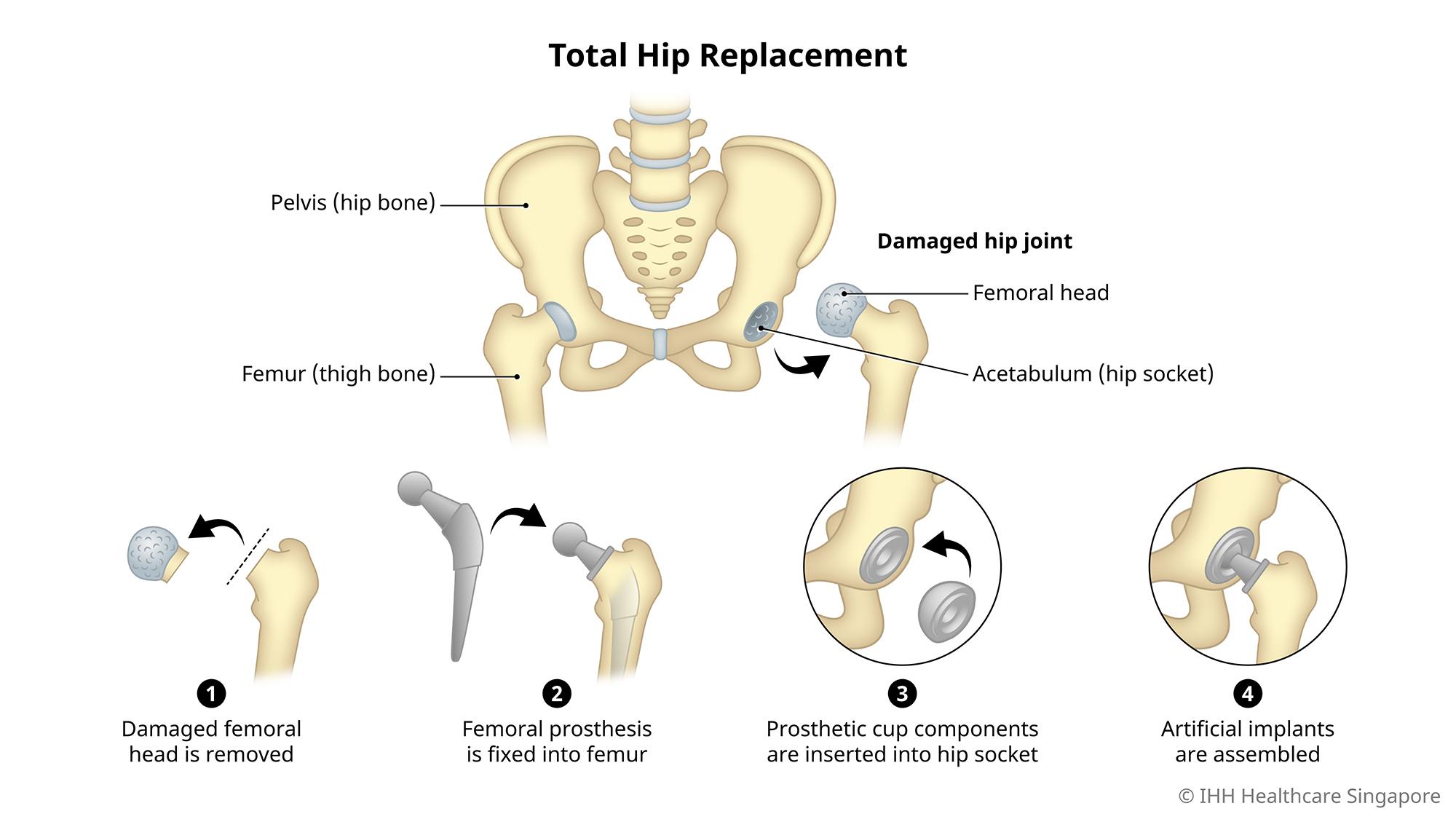 Total hip replacement replaces the femur and the acetabulum with artificial joints
