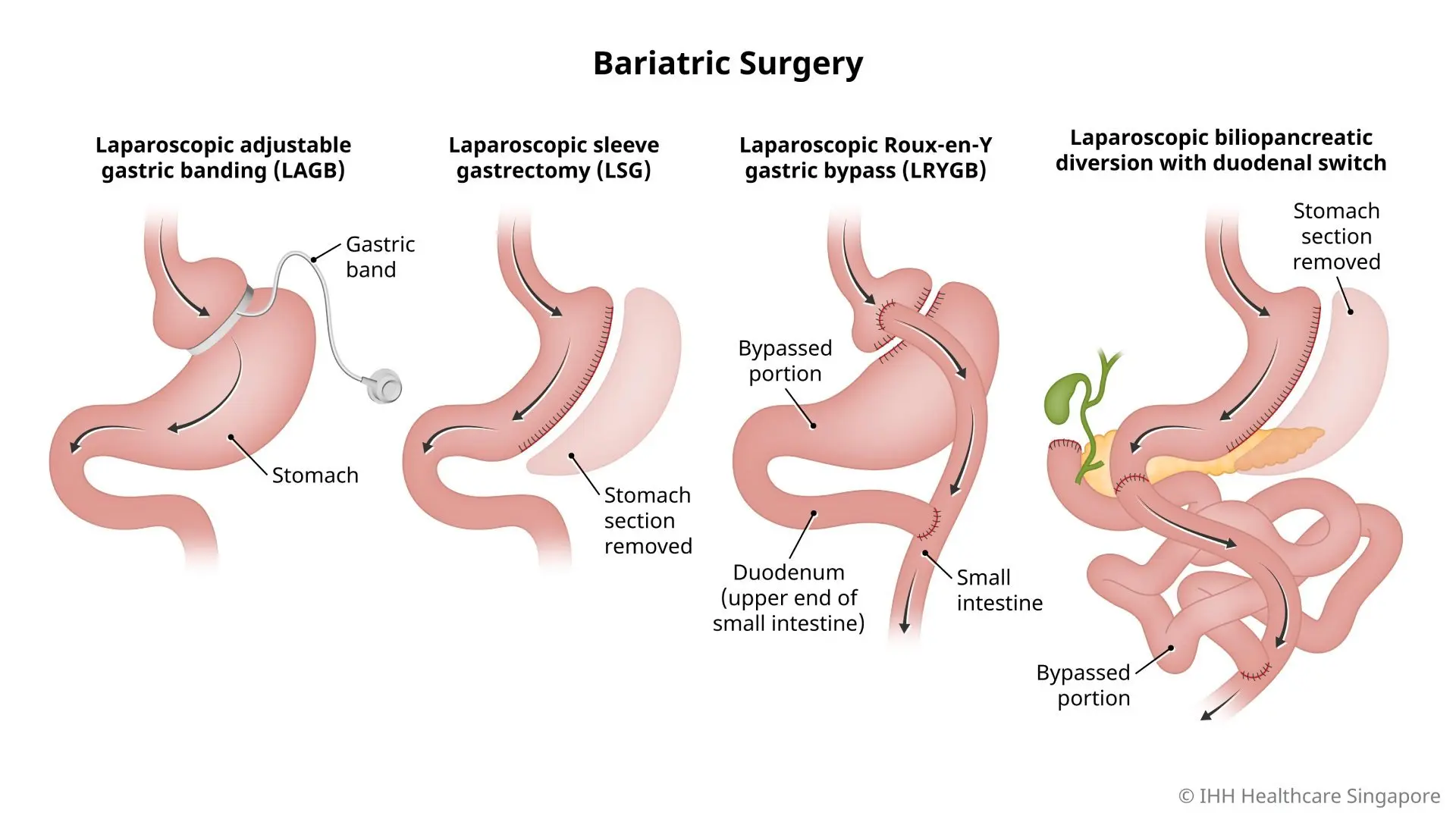 Illustration of bariatric surgery including LAGB, LSG, LRYGB, and laparoscopic biliopancreatic diversion with duodenal switch