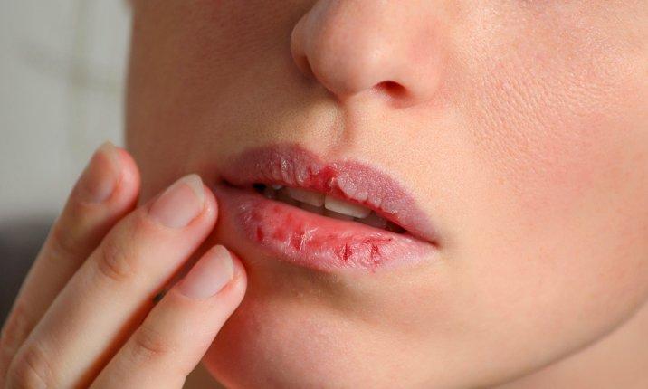 Symptoms of dry lips