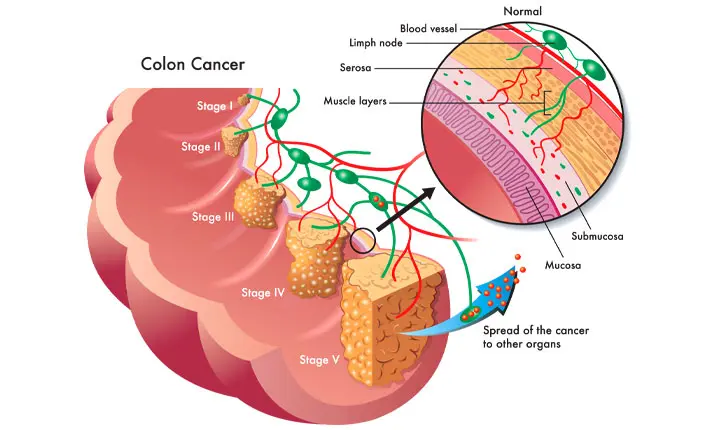 Colorectal cancer at different stages