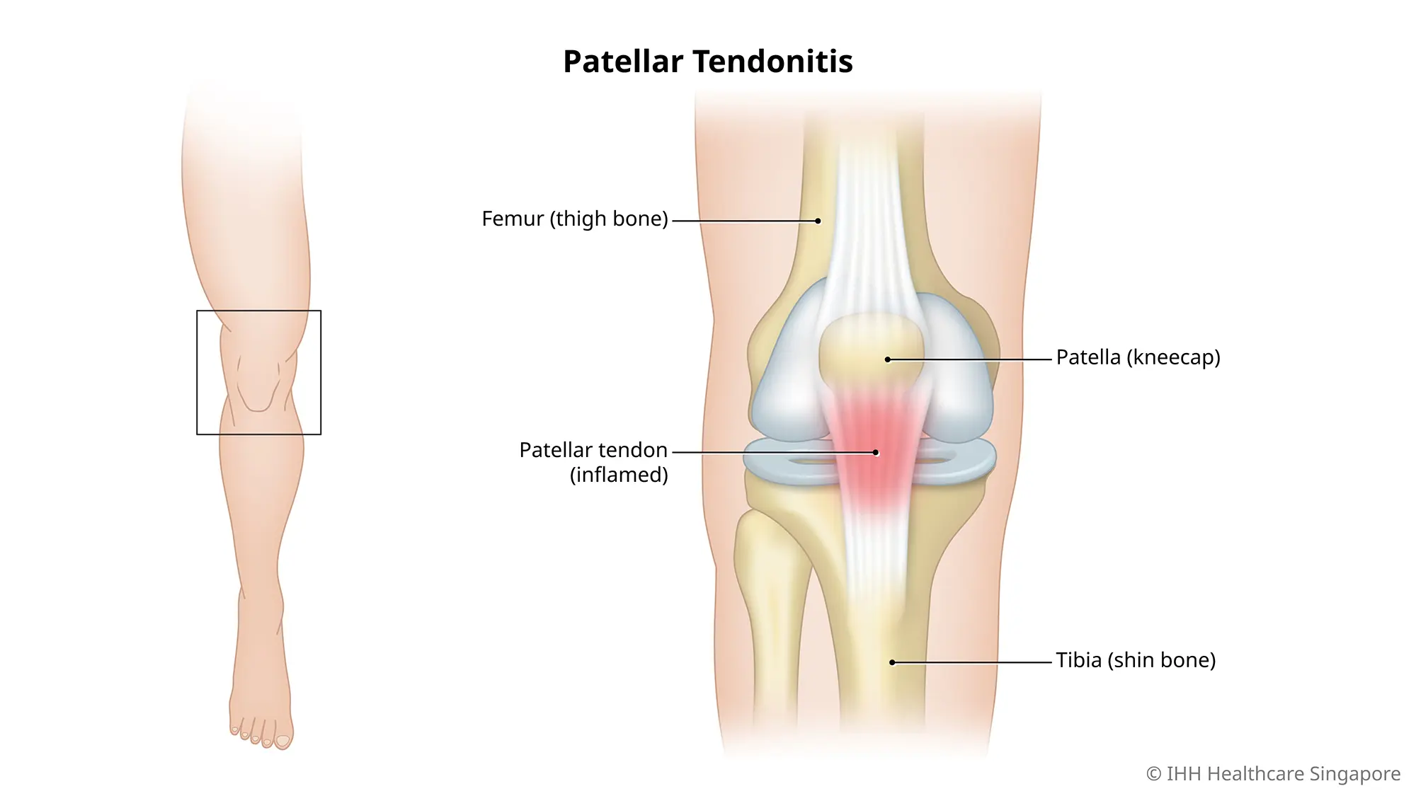 Ilustrasi titik nyeri tendonitis patela