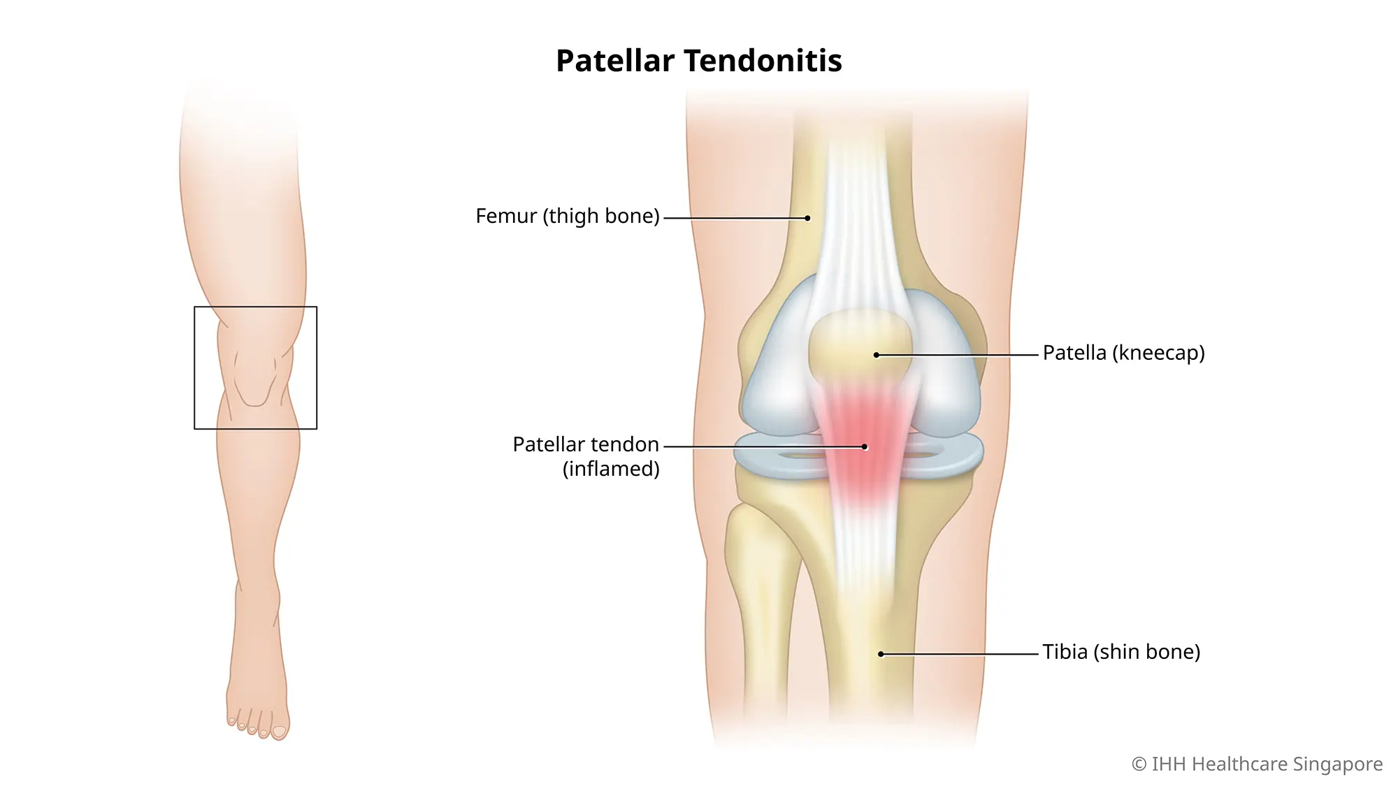 Symptoms & Causes - Patellar Tendonitis (Jumper's Knee)