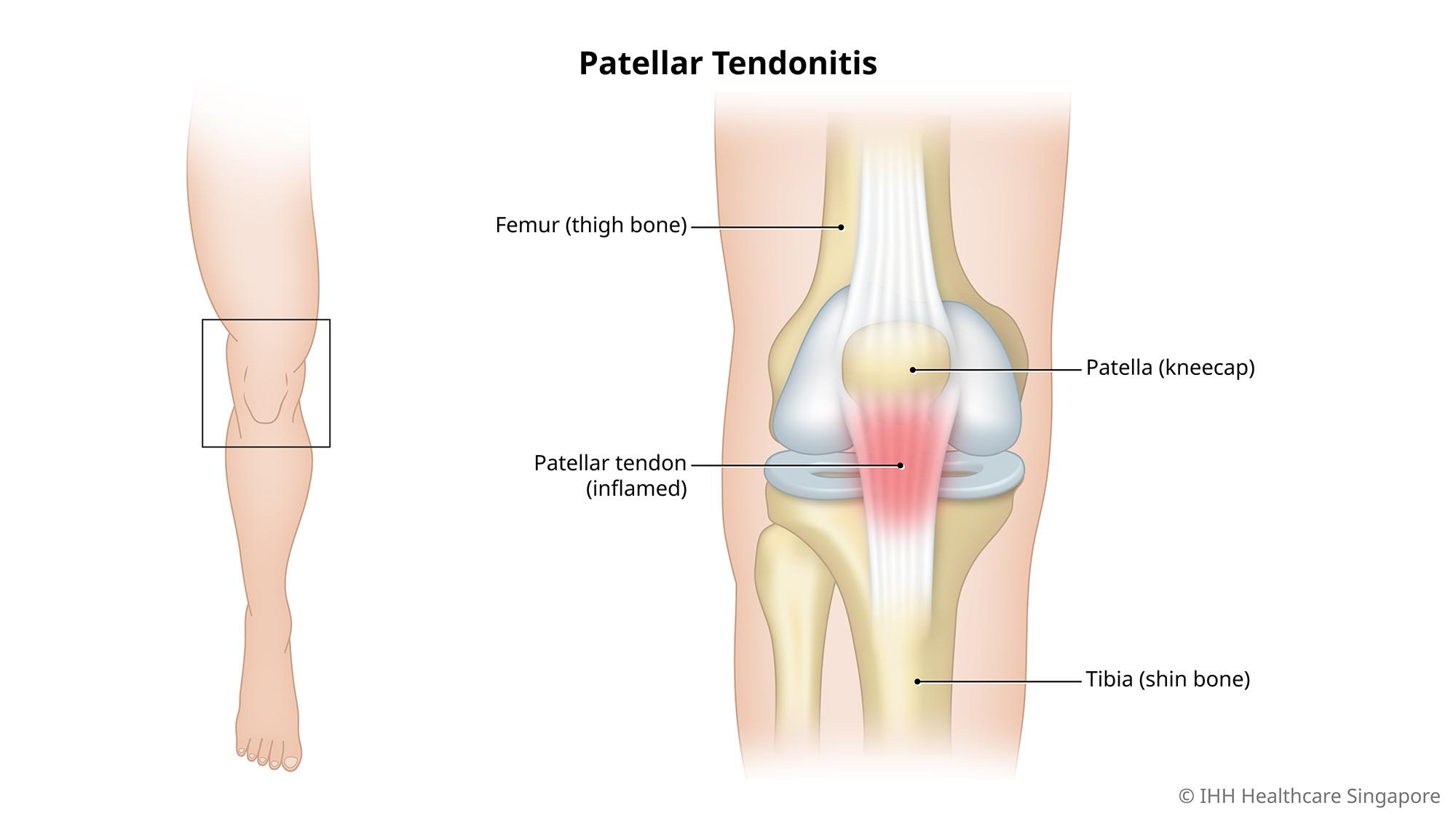 Diagram illustrating the pain points of patellar tendonitis