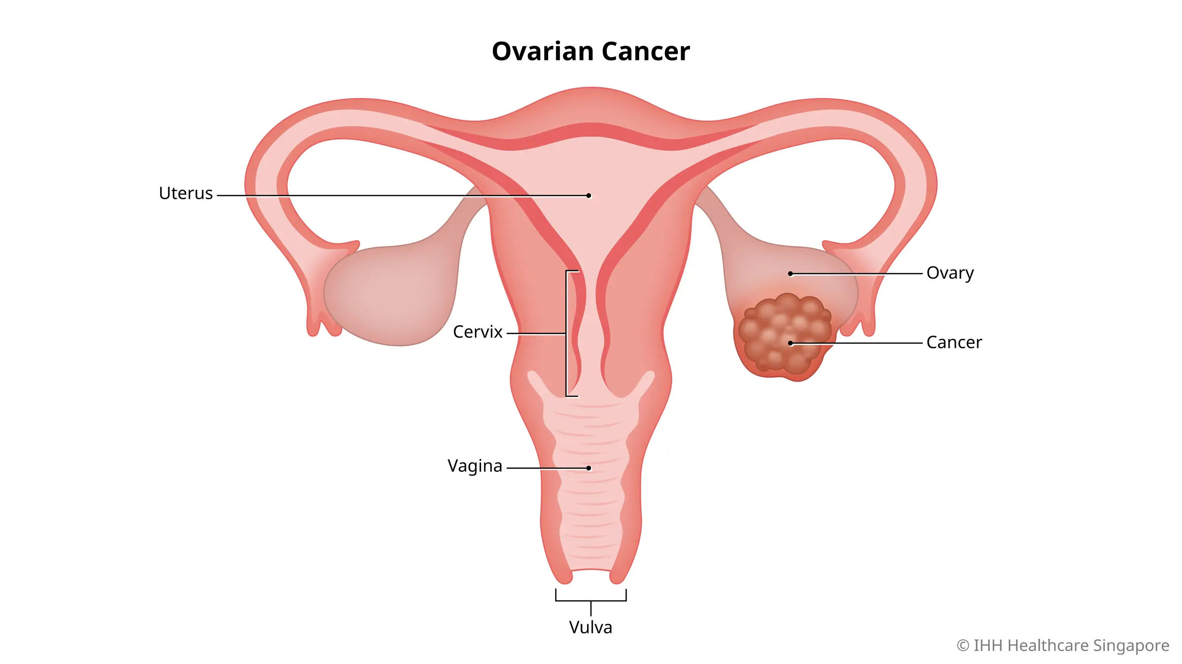 Ovarian là gì? Tìm hiểu về cấu tạo và chức năng của buồng trứng