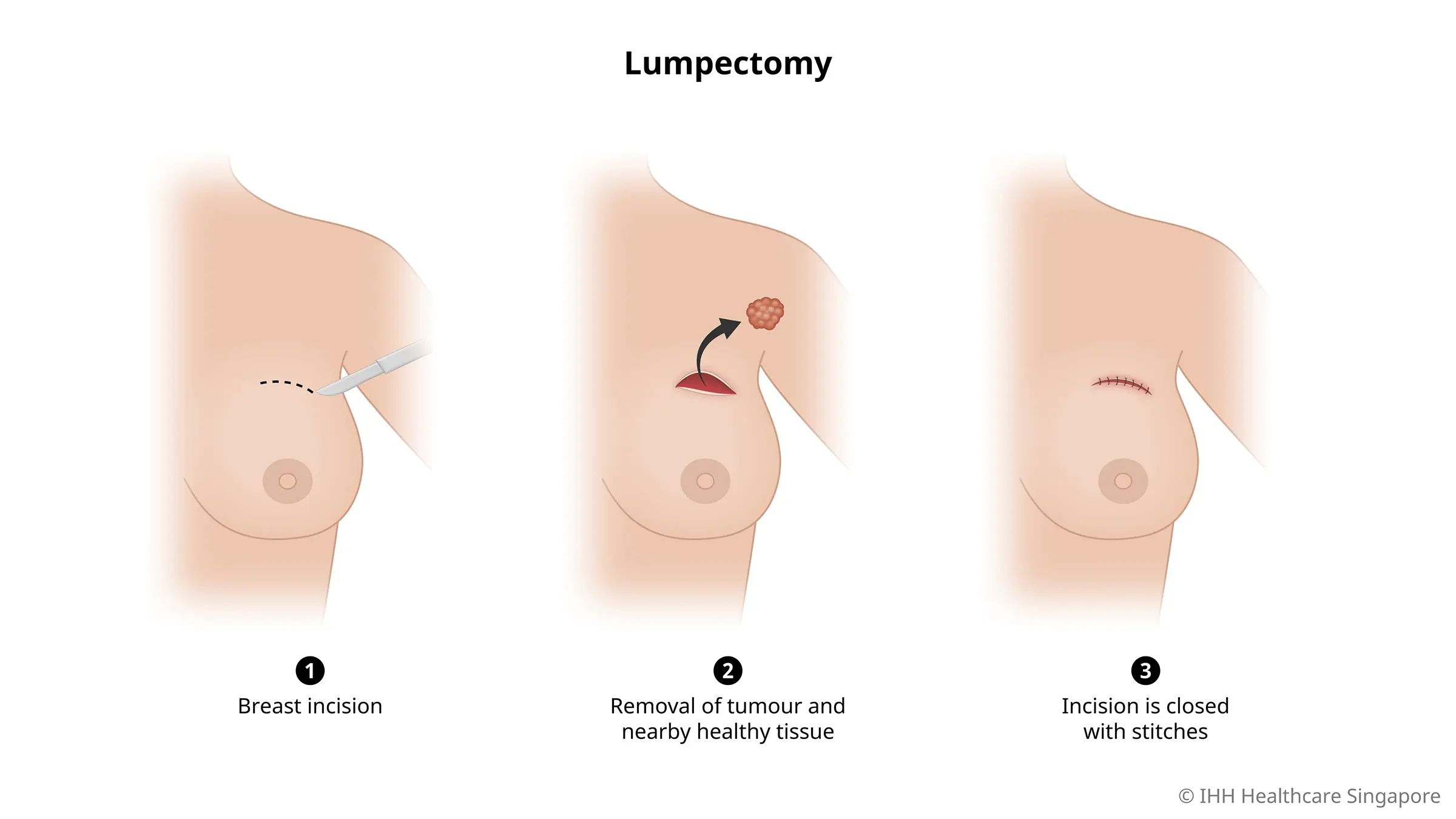 Lumpektomi