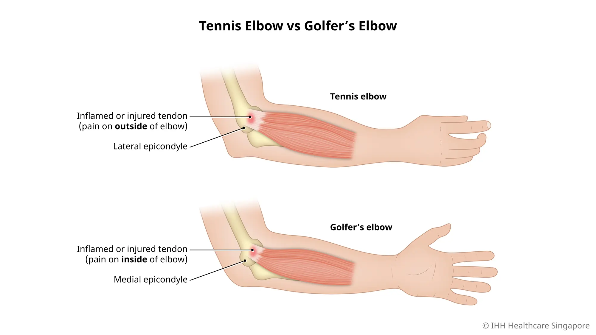 Sự khác biệt giữa khuỷu tay tennis và khuỷu tay golf