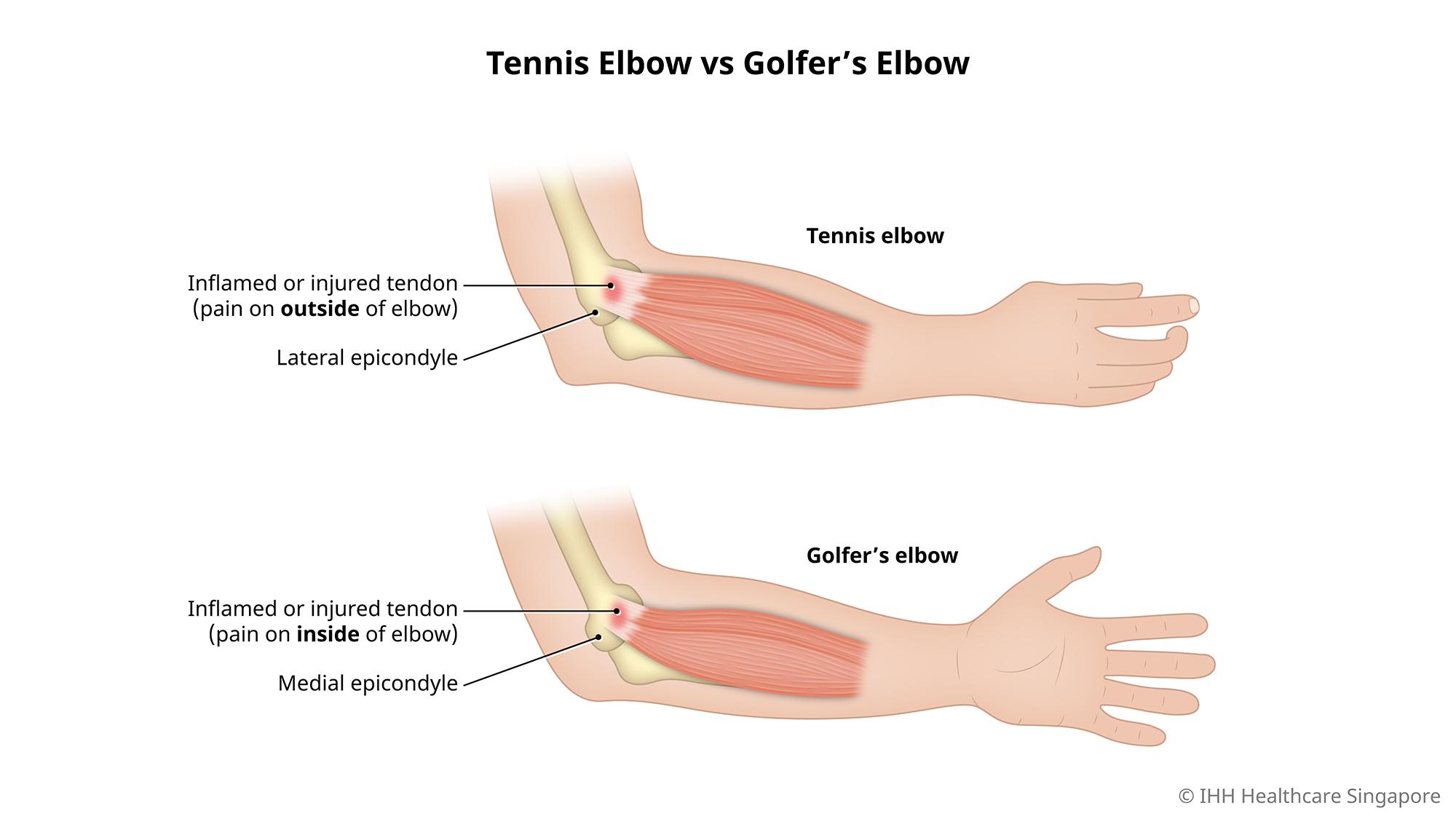 Difference between a tennis elbow and a golfer's elbow