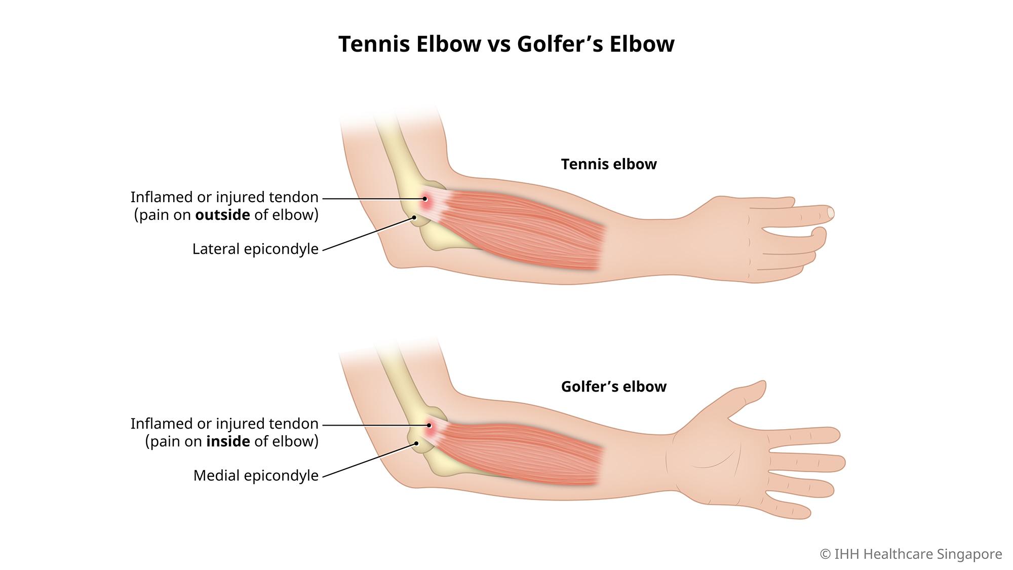 elbow tendon injury symptoms