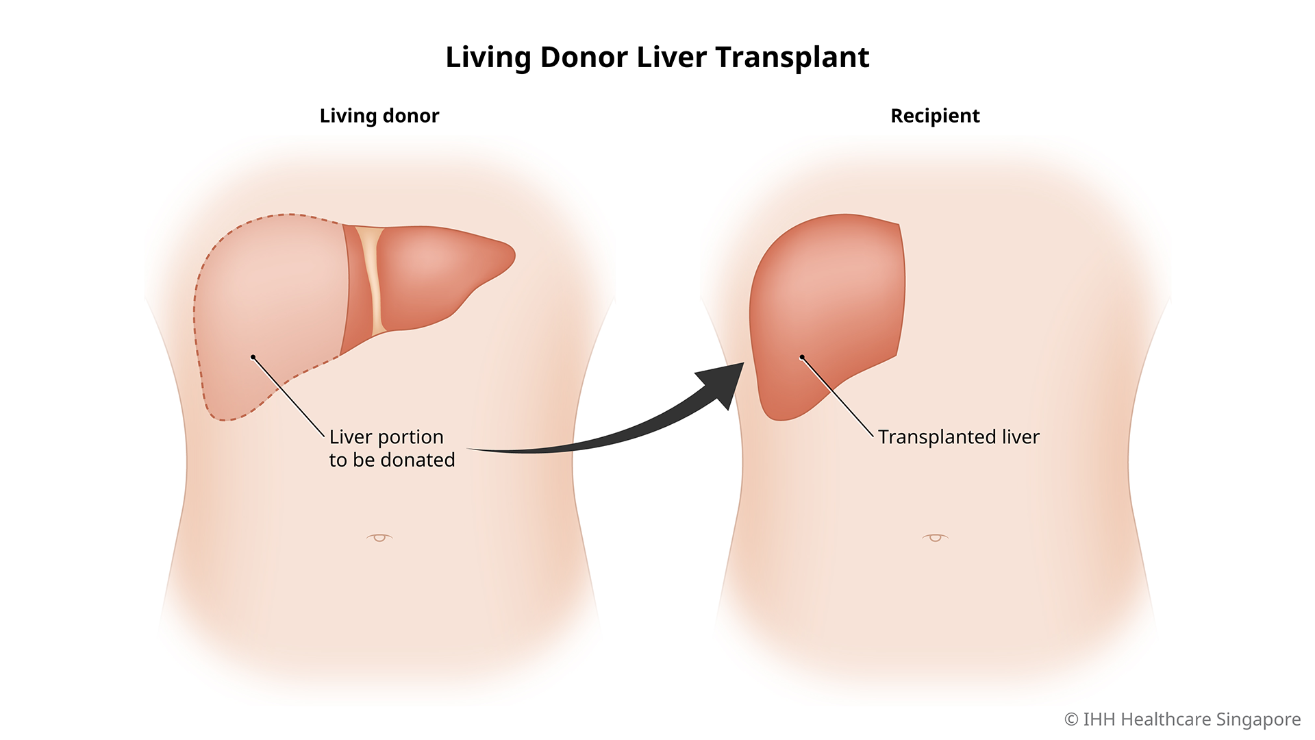 Living Donor Liver Transplant 201