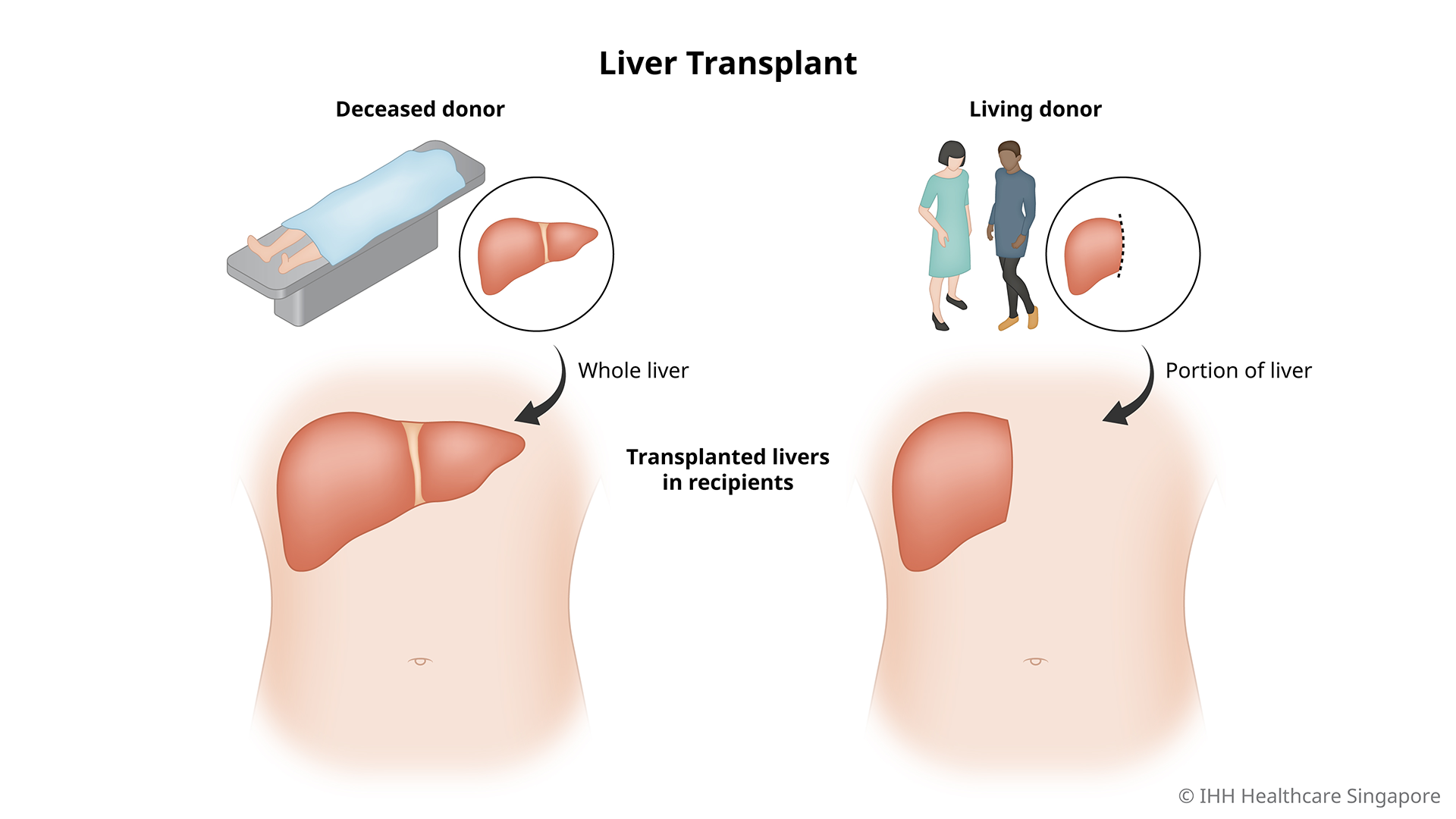 Liver Transplant 7 01